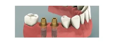 La imagen 1 de la Empresa FIRST DENTAL Salud y Medicina en Majadahonda M