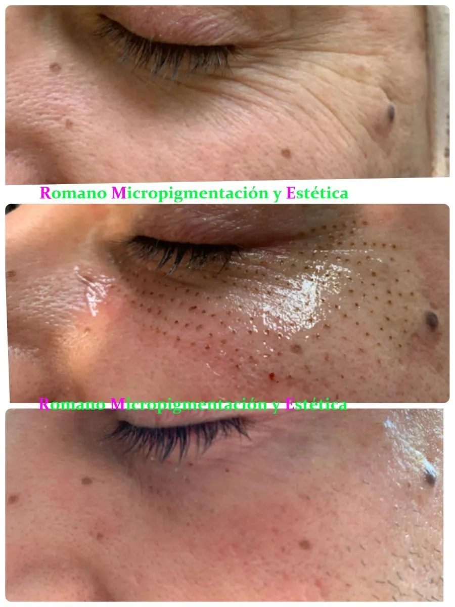 La imagen 6 de la Empresa ROMANO MICROPIGMENTACIÓN ESTÉTICA ONCOLÓGICA PARAMÉDICA Y MICROBLADING